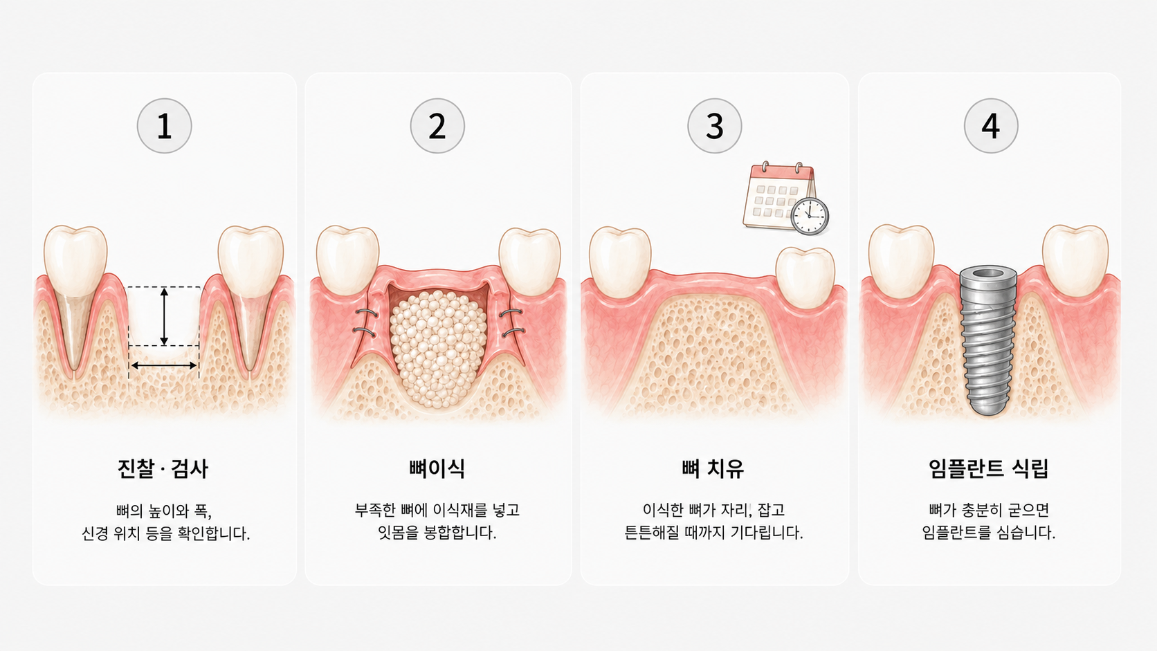 뼈이식 임플란트 4단계 일러스트 — 진찰·검사, 뼈이식, 뼈 치유, 임플란트 식립