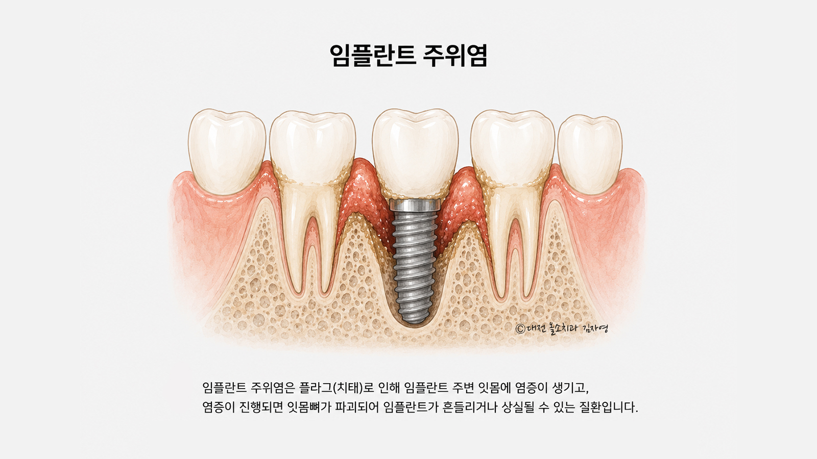 임플란트 주위염 — 임플란트 주변 잇몸에 염증이 생기고 잇몸뼈가 내려앉은 단면 일러스트