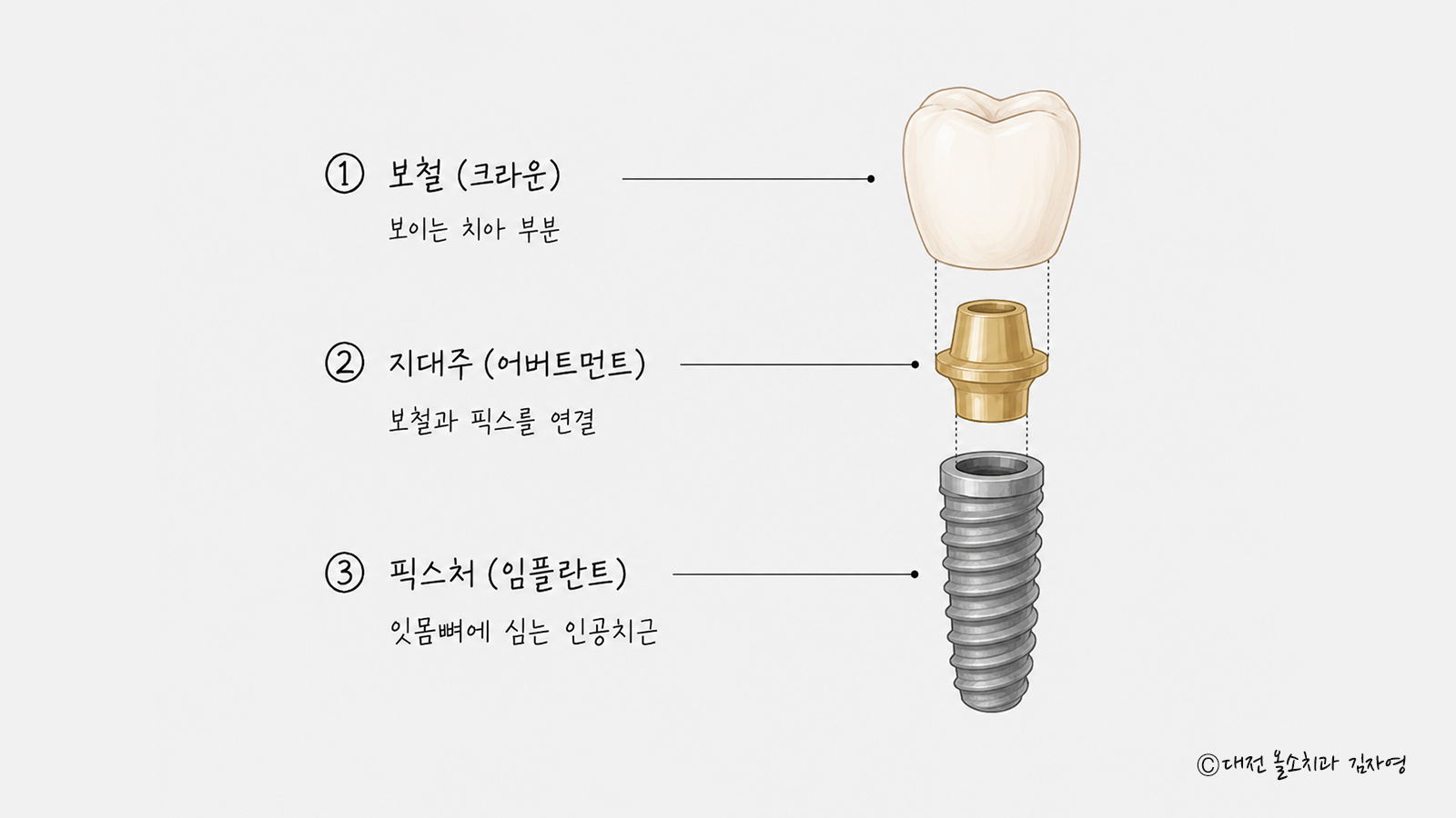 임플란트 세 부분 분해도 — 보철(크라운), 지대주(어버트먼트), 잇몸뼈에 심는 픽스처